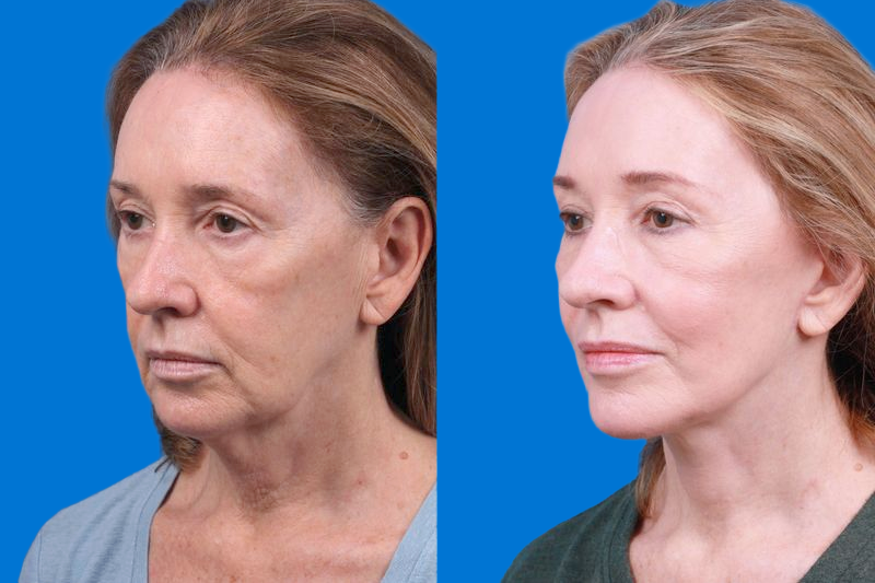 Facelift Before & After Gallery - Patient 146528293 - Image 4