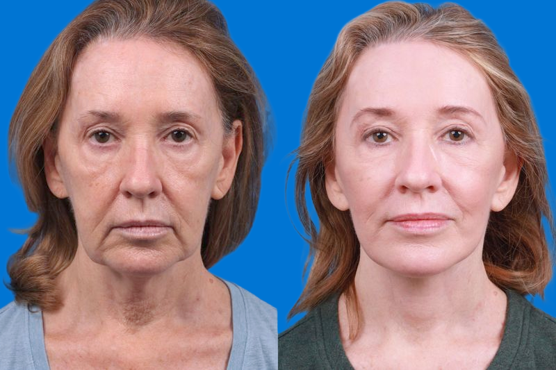 Facelift Before & After Gallery - Patient 146528293 - Image 1