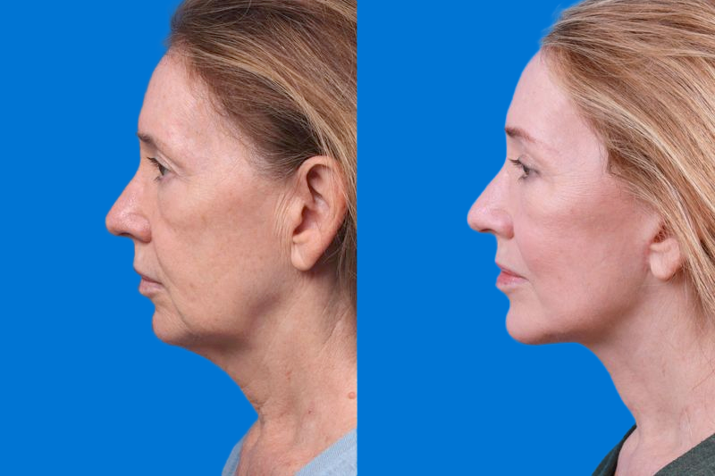Facelift Before & After Gallery - Patient 146528293 - Image 5