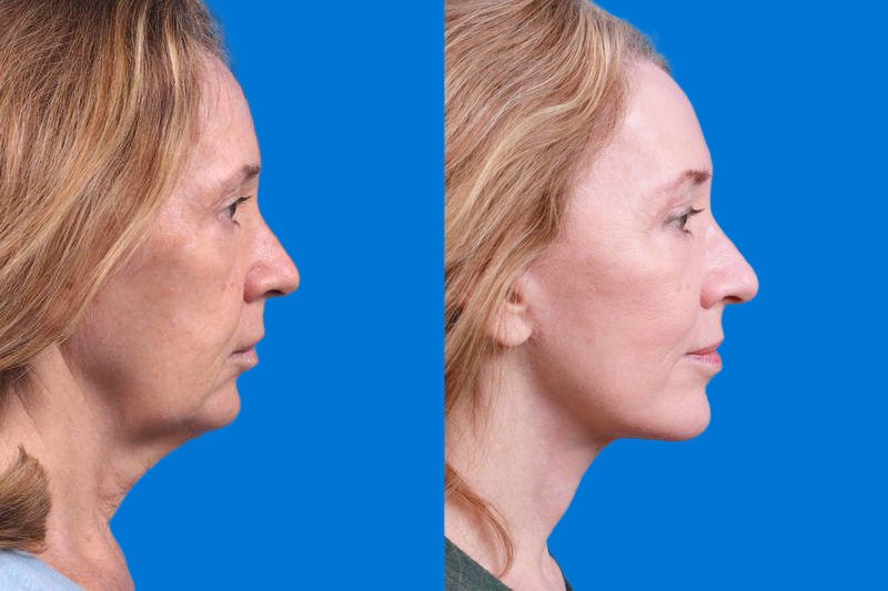 Facelift Before & After Gallery - Patient 146528293 - Image 3