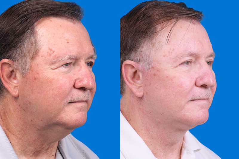 Eyelid Surgery Before & After Gallery - Patient 142734 - Image 2