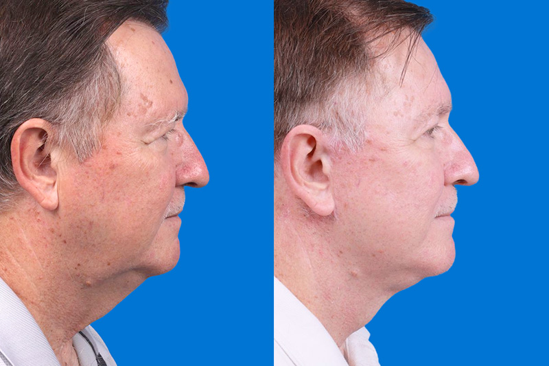 Eyelid Surgery Before & After Gallery - Patient 142734 - Image 3