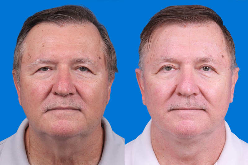 Eyelid Surgery Before & After Gallery - Patient 142734 - Image 1