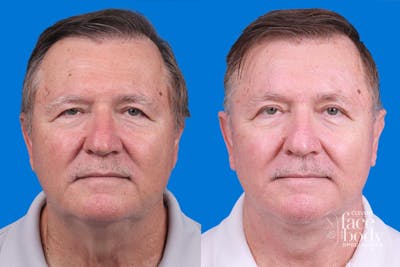Eyelid Surgery Before & After Gallery - Patient 142734 - Image 1