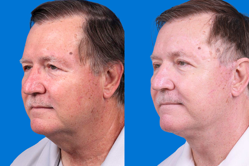 Eyelid Surgery Before & After Gallery - Patient 142734 - Image 4