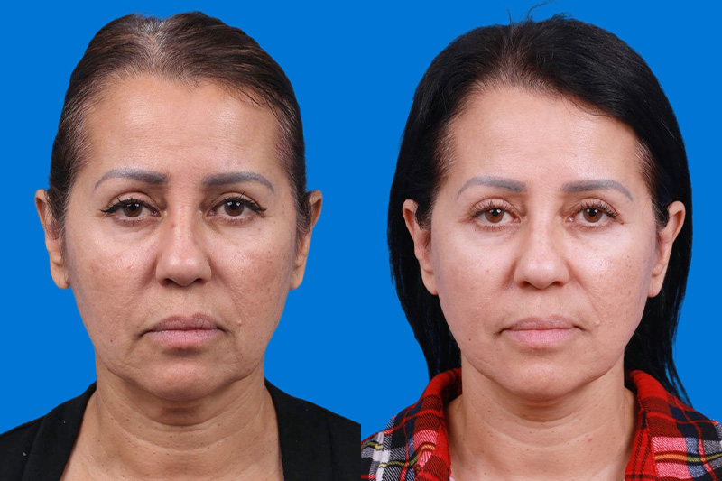 Facelift Before & After Gallery - Patient 149384769 - Image 1