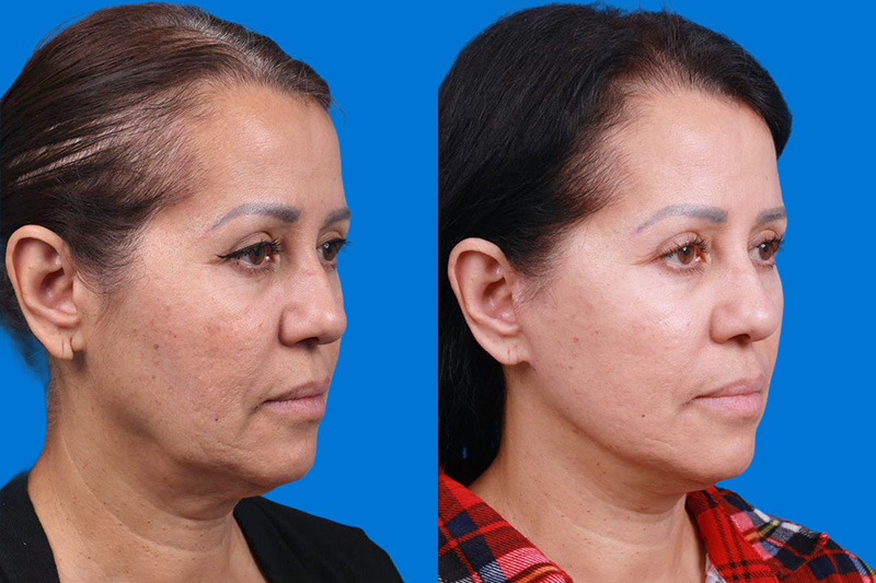 Facelift Before & After Gallery - Patient 149384769 - Image 2