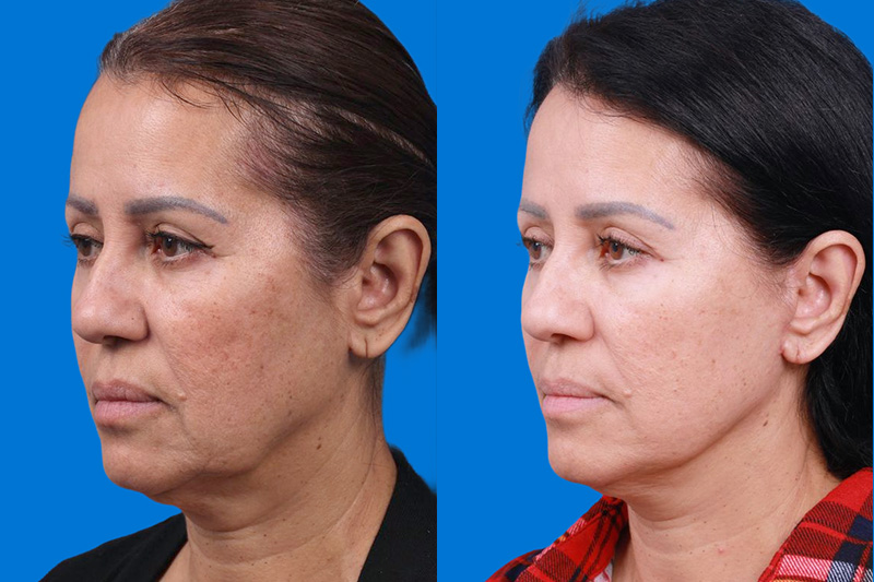 Facelift Before & After Gallery - Patient 149384769 - Image 4