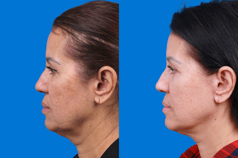 Facelift Before & After Gallery - Patient 149384769 - Image 5