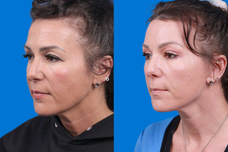 Facelift Before & After Gallery - Patient 146900095 - Image 4