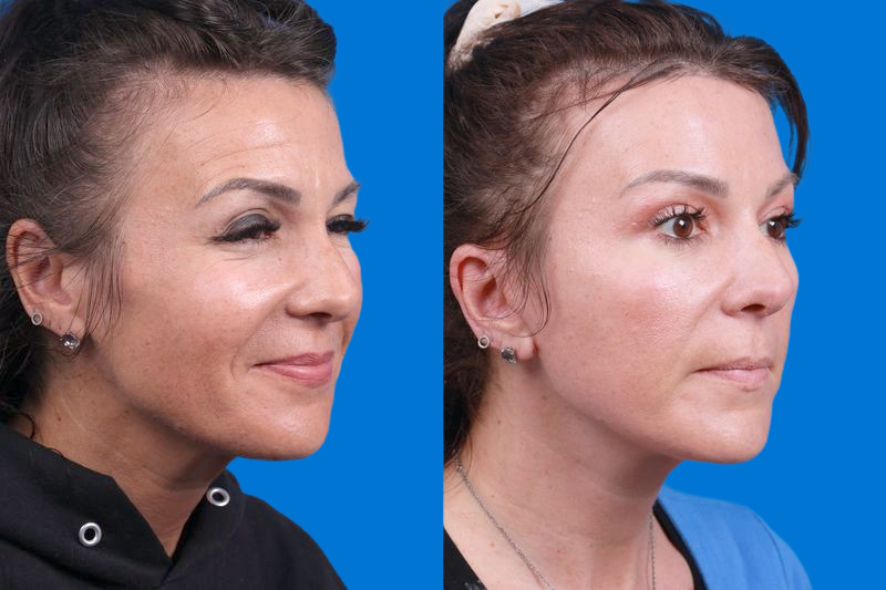 Facelift Before & After Gallery - Patient 146900095 - Image 2