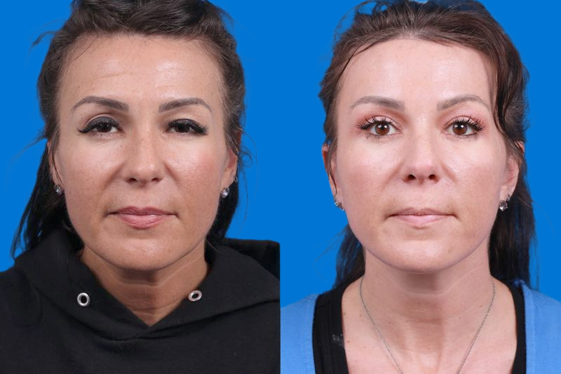 Facelift Before & After Gallery - Patient 146900095 - Image 1