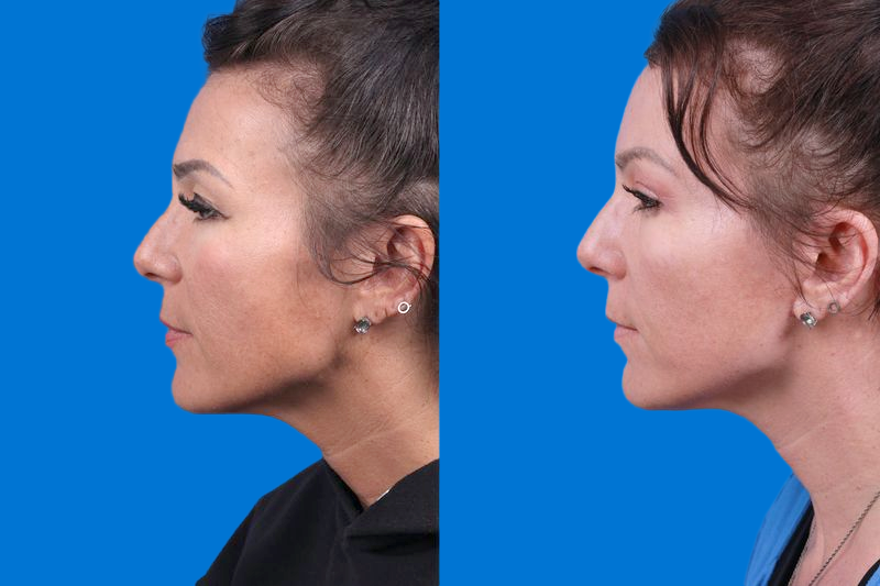 Facelift Before & After Gallery - Patient 146900095 - Image 5