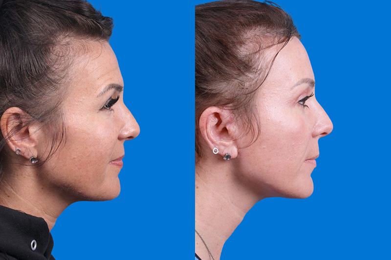 Facelift Before & After Gallery - Patient 146900095 - Image 3