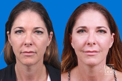 Eyelid Surgery Before & After Gallery - Patient 899501 - Image 1
