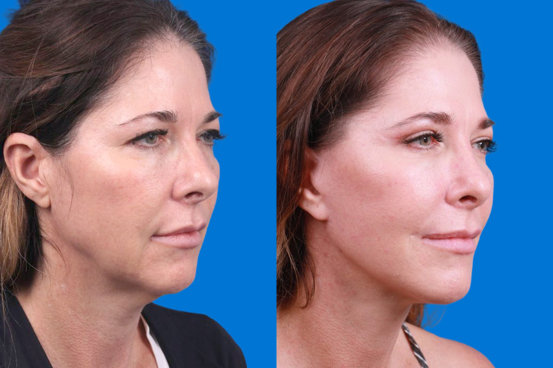 Facelift Before & After Gallery - Patient 159537382 - Image 2