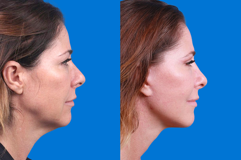 Facelift Before & After Gallery - Patient 159537382 - Image 3