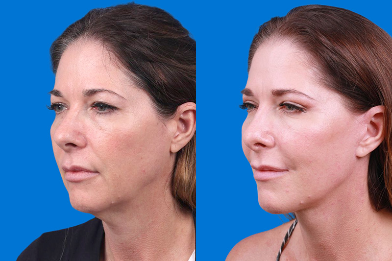 Facelift Before & After Gallery - Patient 159537382 - Image 4