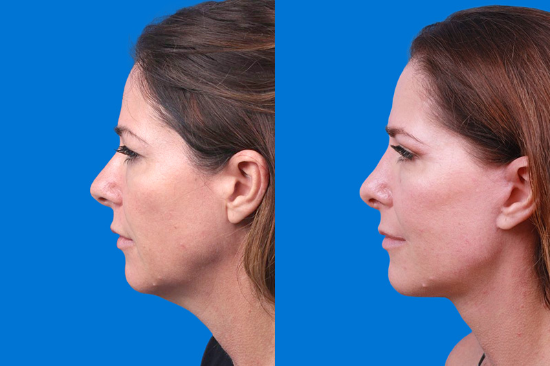 Facelift Before & After Gallery - Patient 159537382 - Image 5