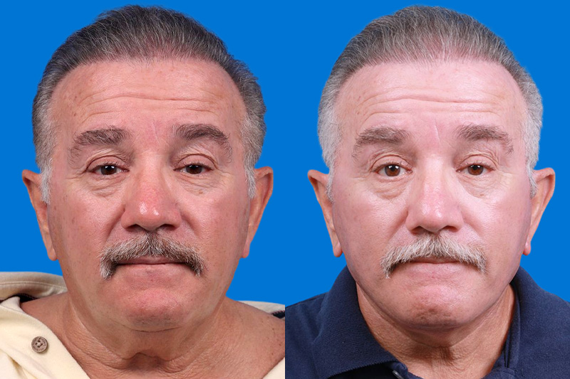 Facelift Before & After Gallery - Patient 150585031 - Image 1