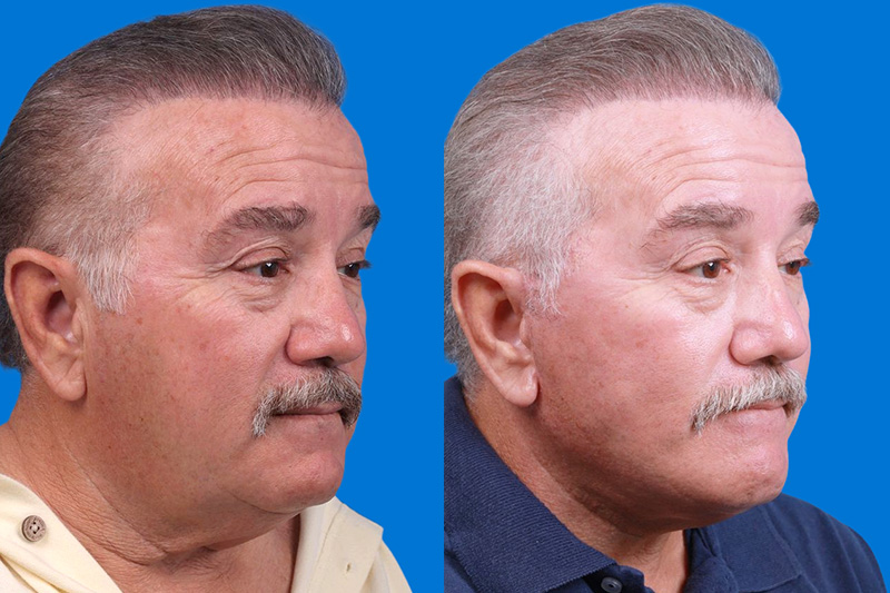 Facelift Before & After Gallery - Patient 150585031 - Image 2