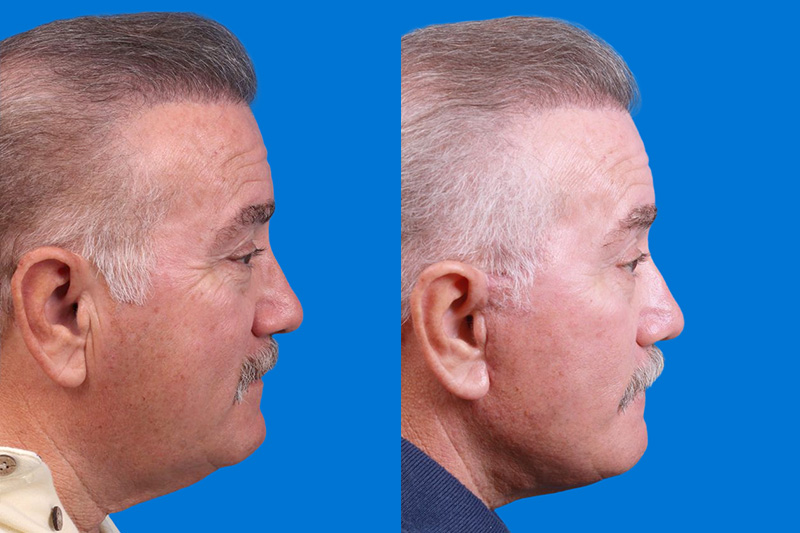 Facelift Before & After Gallery - Patient 150585031 - Image 3