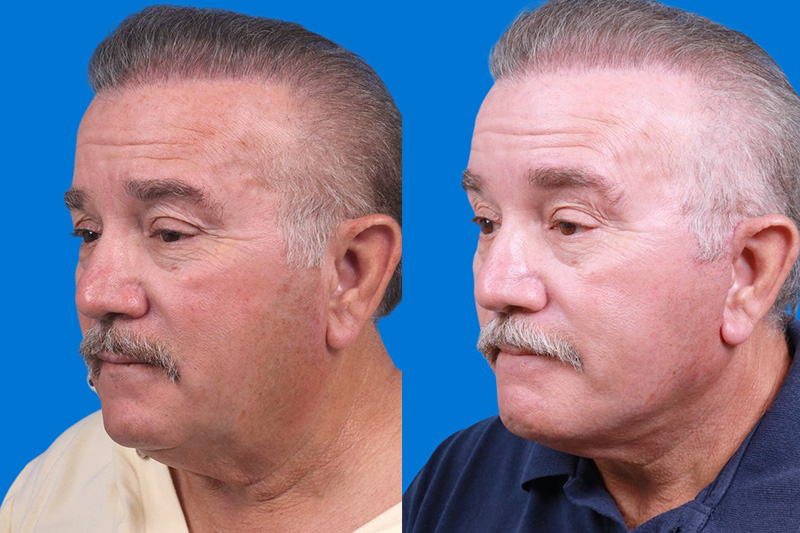 Facelift Before & After Gallery - Patient 150585031 - Image 4
