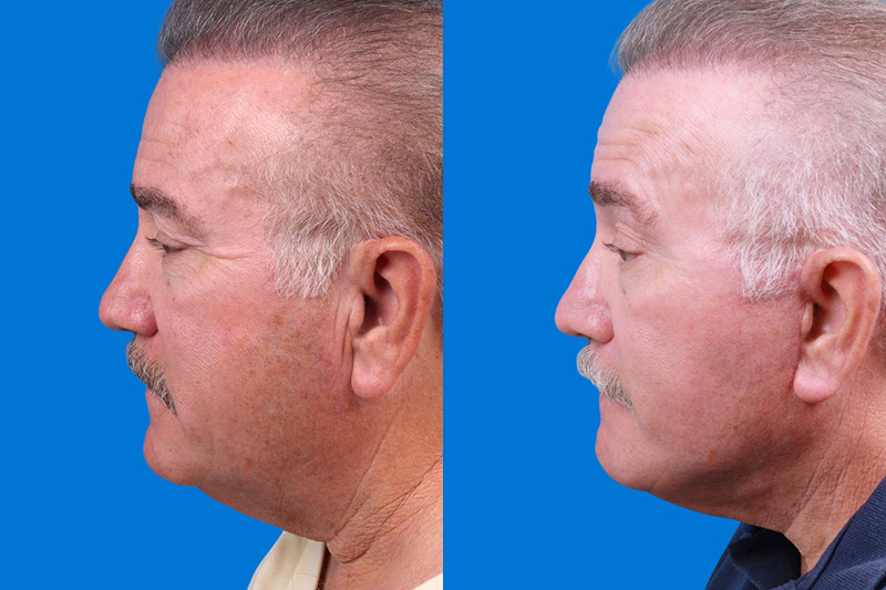 Facelift Before & After Gallery - Patient 150585031 - Image 5