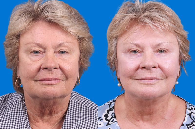 Eyelid Surgery Before & After Gallery - Patient 325629 - Image 1