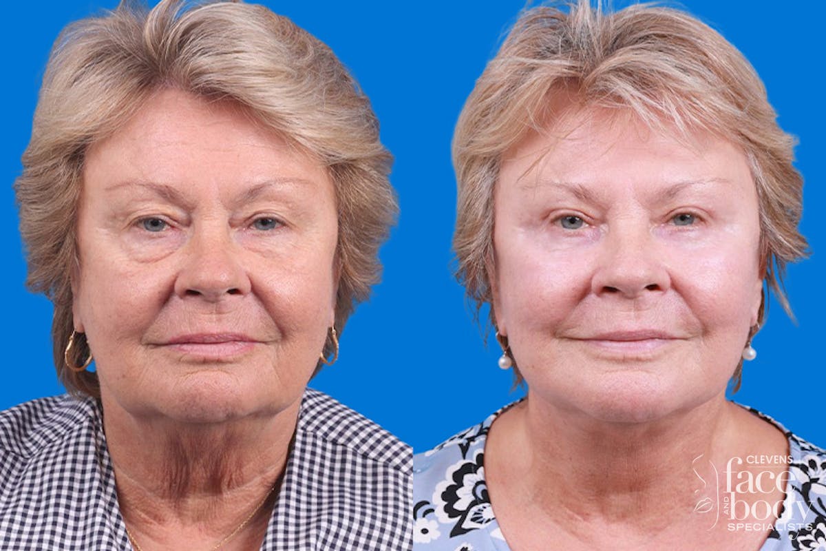 Eyelid Surgery Before & After Gallery - Patient 325629 - Image 1