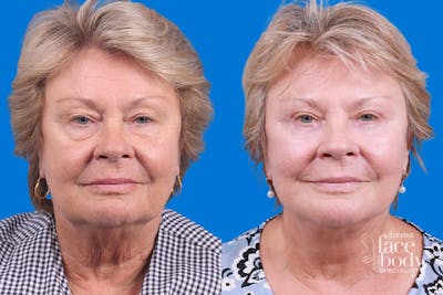 Eyelid Surgery Before & After Gallery - Patient 325629 - Image 1