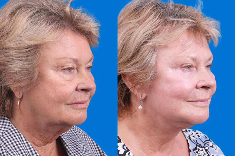 Nasolabial Folds Before & After Gallery - Patient 147583 - Image 2
