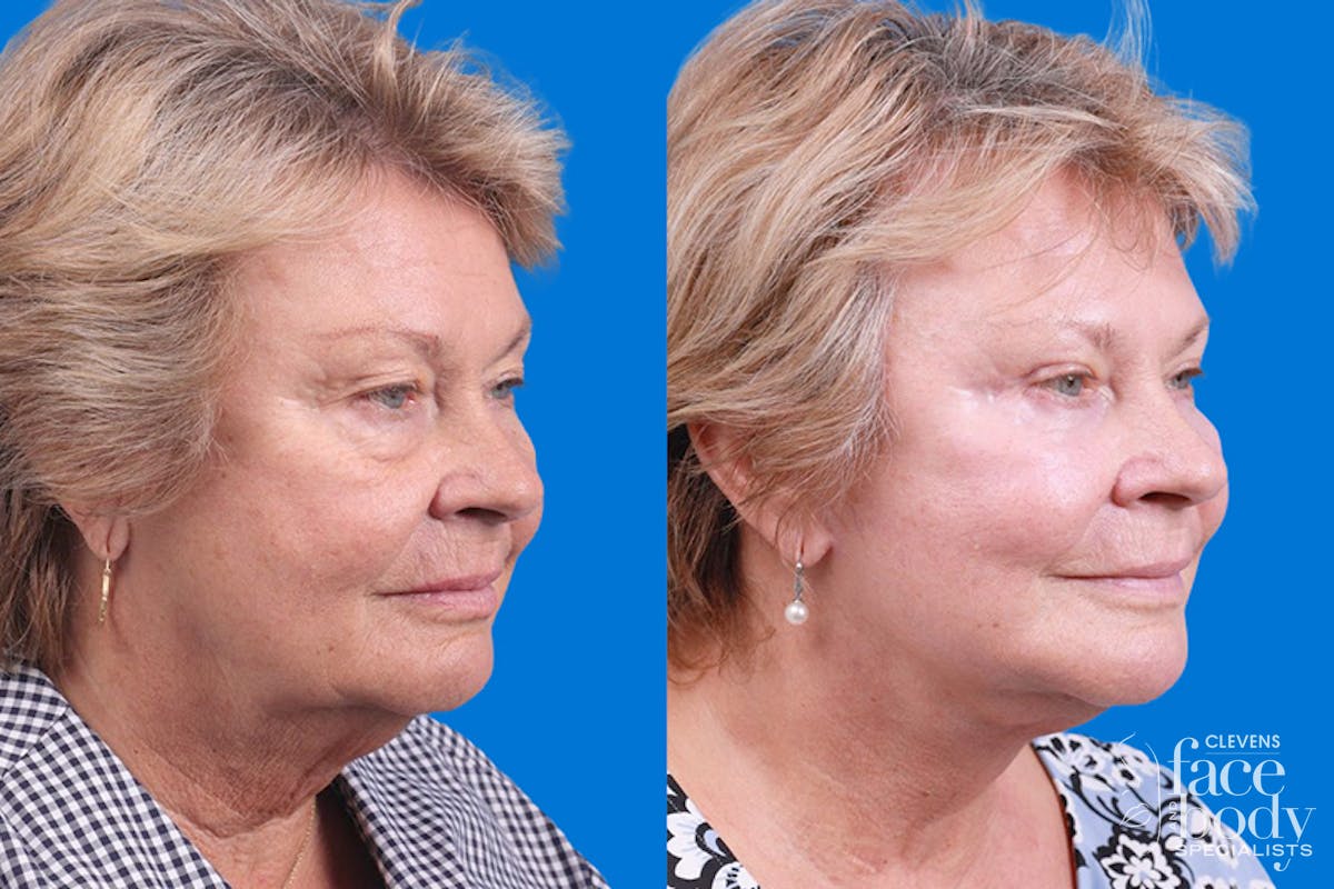 Eyelid Surgery Before & After Gallery - Patient 325629 - Image 2