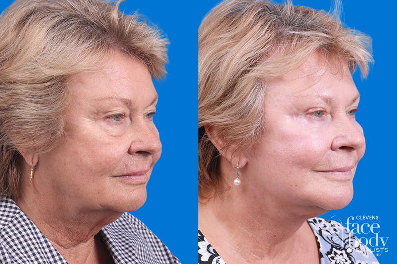 Eyelid Surgery Before & After Gallery - Patient 325629 - Image 2
