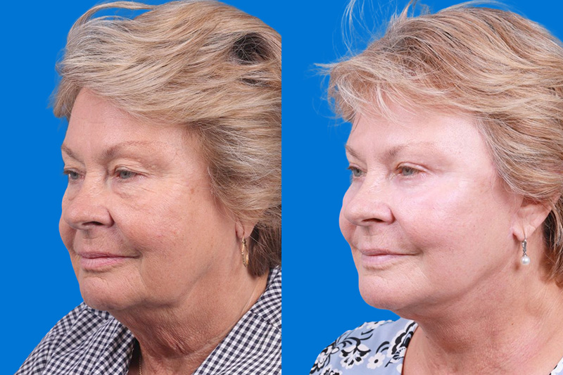Nasolabial Folds Before & After Gallery - Patient 147583 - Image 4
