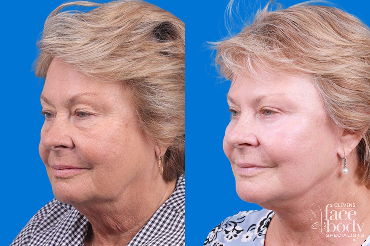 Eyelid Surgery Before & After Gallery - Patient 325629 - Image 4