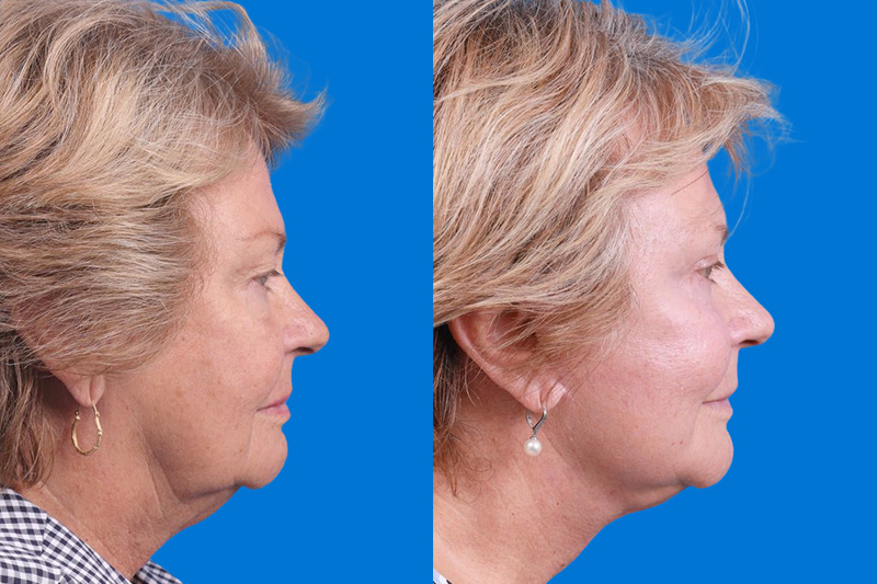 Nasolabial Folds Before & After Gallery - Patient 147583 - Image 3