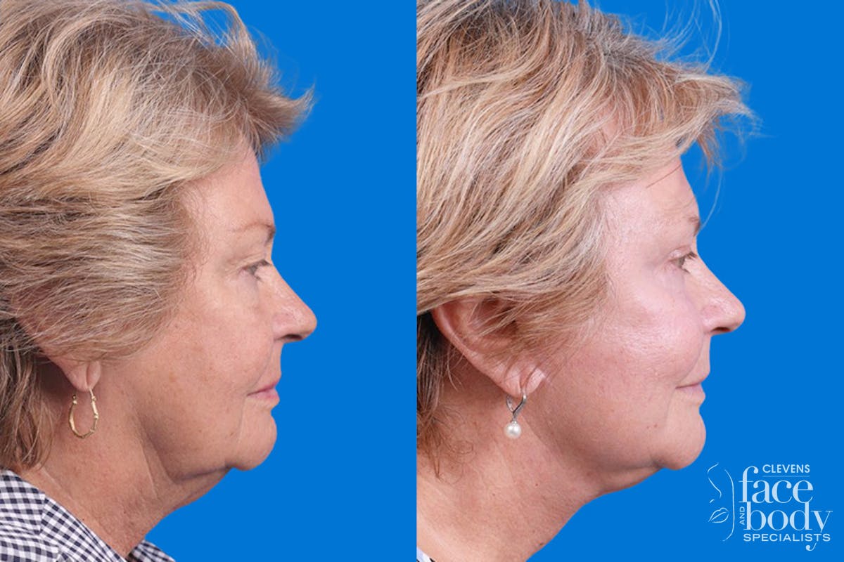 Eyelid Surgery Before & After Gallery - Patient 325629 - Image 3