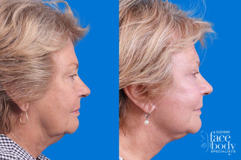 Eyelid Surgery Before & After Gallery - Patient 325629 - Image 3