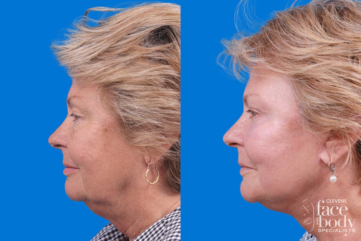 Eyelid Surgery Before & After Gallery - Patient 325629 - Image 5