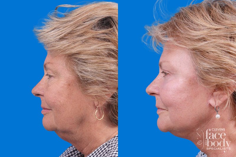 Eyelid Surgery Before & After Gallery - Patient 325629 - Image 5