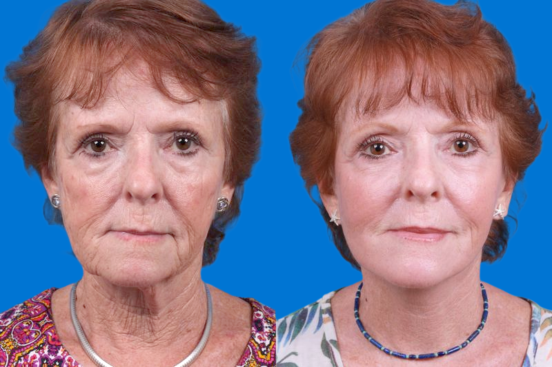 Skin Resurfacing Before & After Gallery - Patient 284553 - Image 1