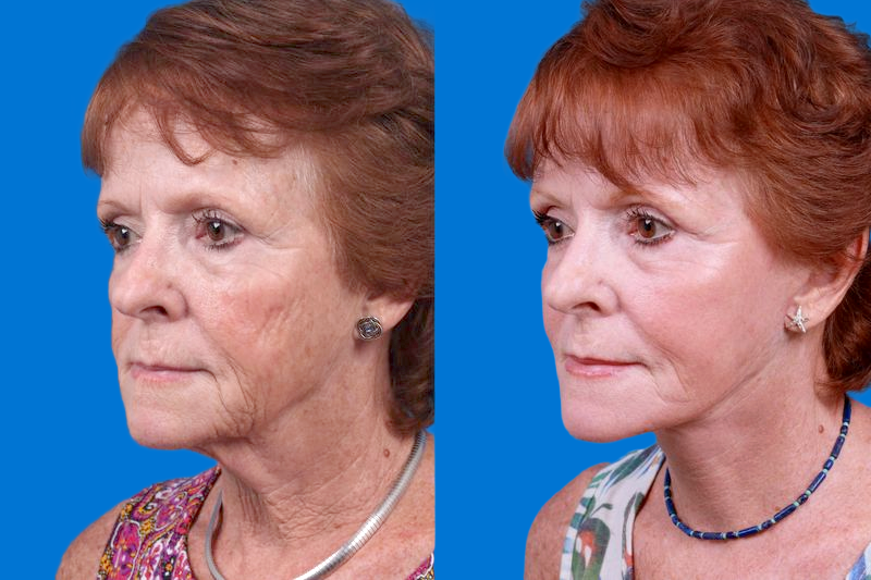 Facelift Before & After Gallery - Patient 160941815 - Image 3
