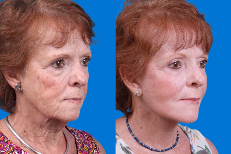 Facelift Before & After Gallery - Patient 160941815 - Image 2