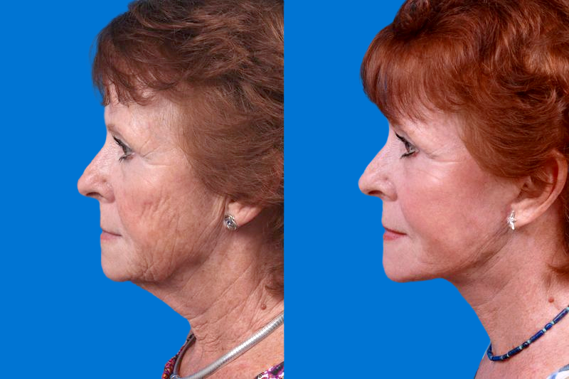 Facelift Before & After Gallery - Patient 160941815 - Image 4