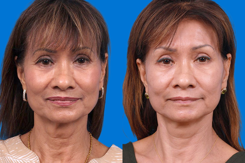 Eyelid Surgery Before & After Gallery - Patient 189262 - Image 1