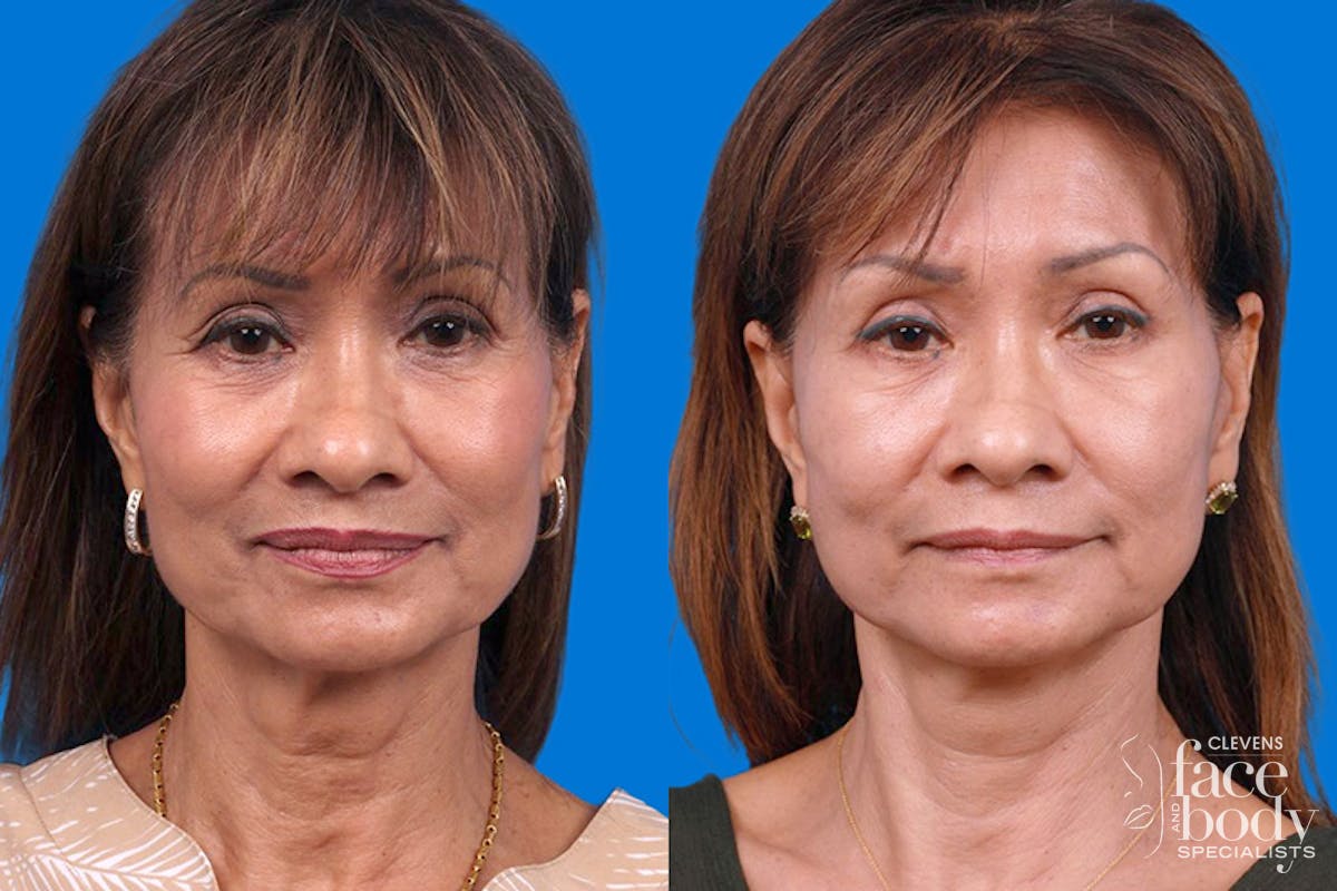 Eyelid Surgery Before & After Gallery - Patient 189262 - Image 1