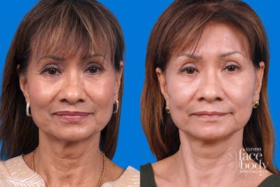 Eyelid Surgery Before & After Gallery - Patient 189262 - Image 1