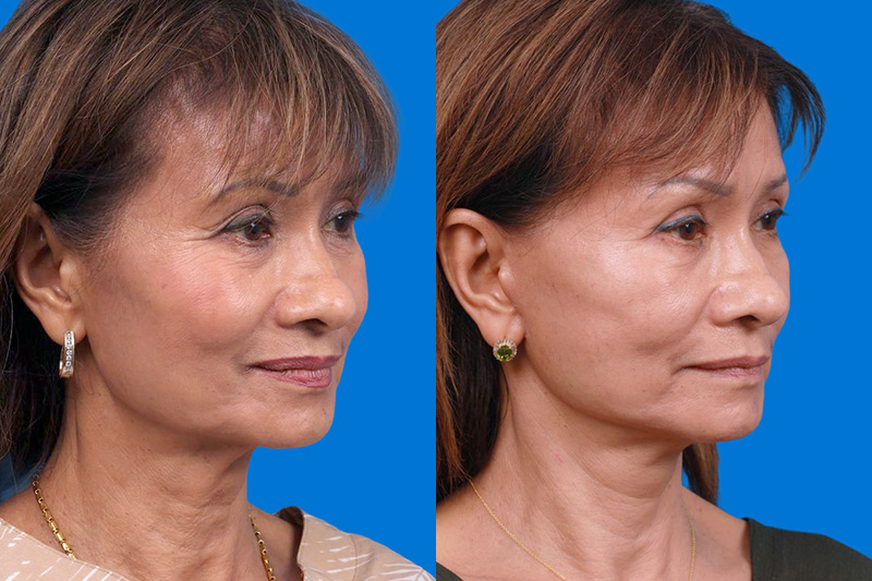 Facelift Before & After Gallery - Patient 179167387 - Image 2