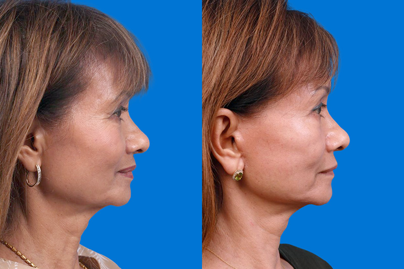 Facelift Before & After Gallery - Patient 179167387 - Image 3